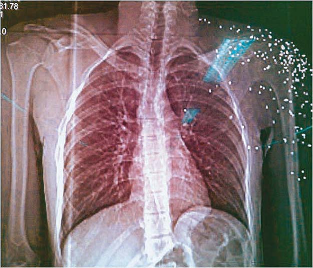 X-ray-chext-showing-pellets-in-the-body-of-the-victim-copy.jpg