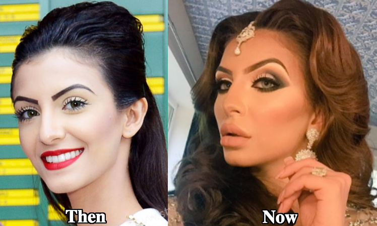 Faryal-Makhdoom-cheek-augmentation-fillers-before-and-after-photos.jpg