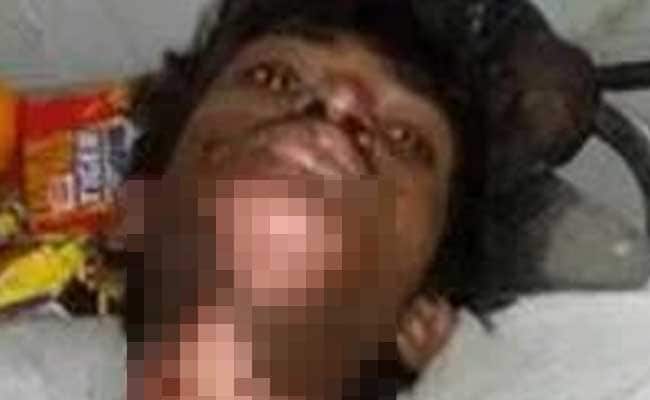 pune-boy-burnt-650_650x400_61453479119.jpg