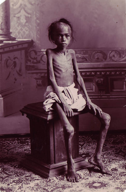 A+famine+victim+boy+in+India.jpg