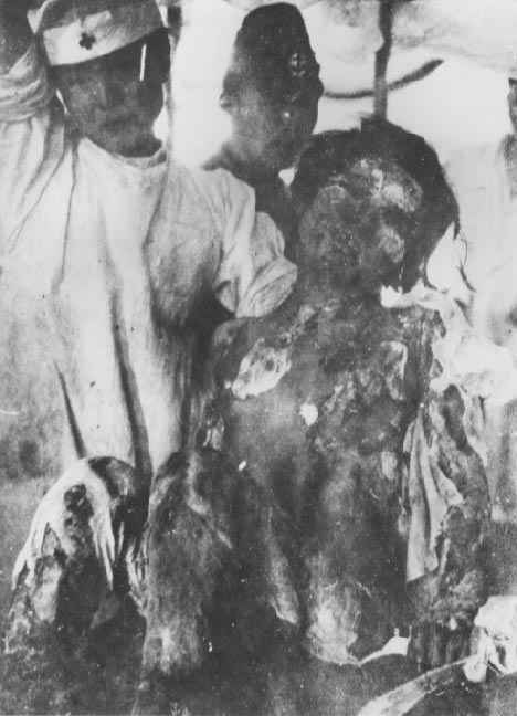 japanese-atomic-bomb-victims-21.jpg