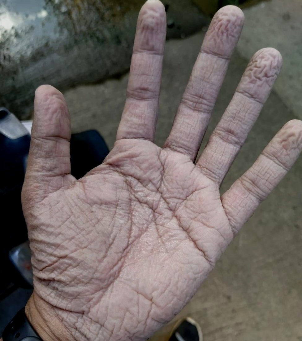 Aseem Gargava, a doctor in Mumbai posted this picture of his palm on social media