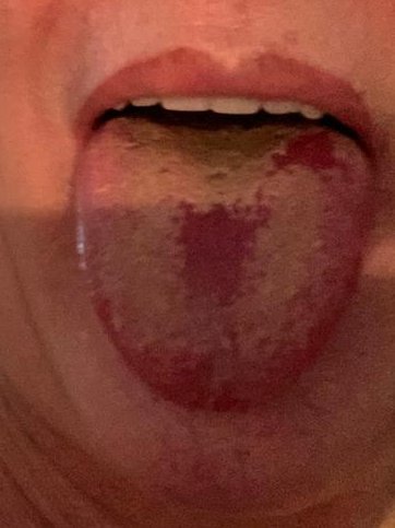 Covid tongue was previously described by Professor Tim Spector, who posted this photo on Twitter