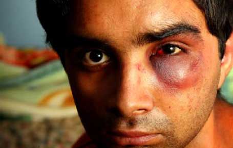 bruised-indian_student.jpg
