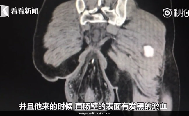 rectum-falls-out-of-body-china-weibo_650x400_81518260971.jpg