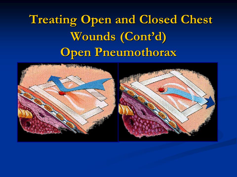 Treating+Open+and+Closed+Chest+Wounds+%28Cont%E2%80%99d%29+Open+Pneumothorax.jpg