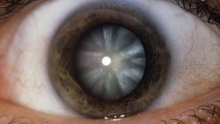 _88653763_m1550050-close-up_of_eye_showing_cataract-spl.jpg