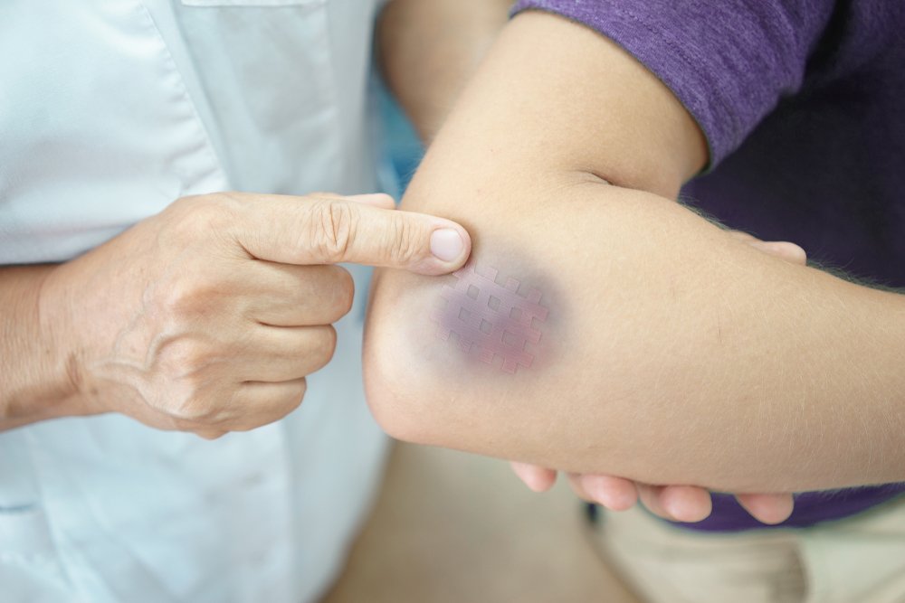 Which Deficiencies Can Cause Bruising? | OmegaQuant