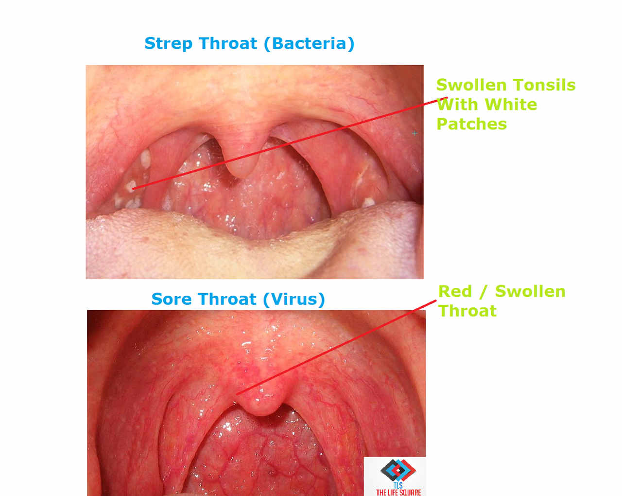 What-Is-Strep-Throat-And-How-Does-It-Differ-From-Common-Sore-Throat.jpg