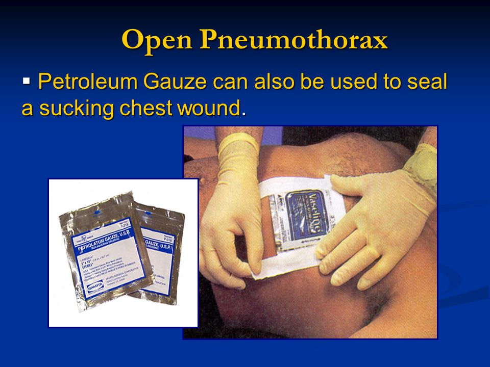 Open+Pneumothorax+Petroleum+Gauze+can+also+be+used+to+seal+a+sucking+chest+wound..jpg