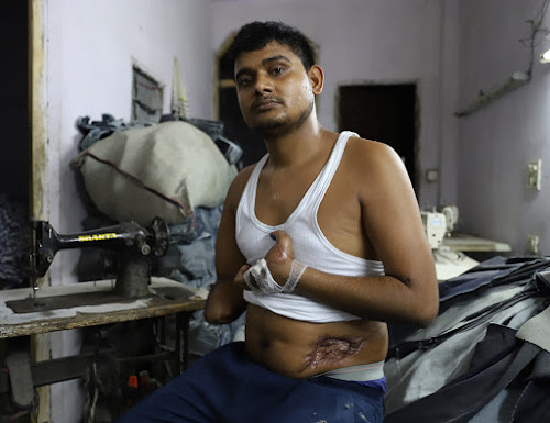 Akram Khan wrote in a police complaint that an explosive was dropped on him from the roof of Mohan Nursing Home, which led to grievous injuries on both his arms. The Delhi Police, however, claimed that he lost his hand in a car accident.. SHAHEEN AHMED FOR THE CARAVAN