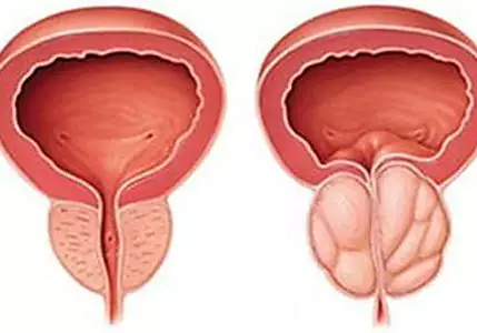 Do this Immediately if You Have Enlarged Prostatic (Watch)
