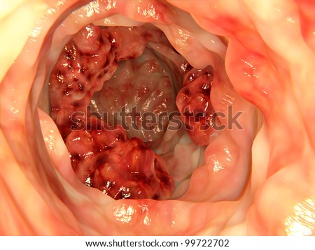 stock-photo-colon-cancer-99722702.jpg