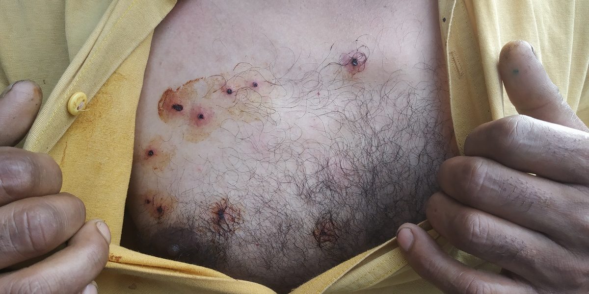 On-Sept-1-a-local-resident-of-Soura-Srinagar-showing-pellet-wounds-on-his-chest.-He-said-he-was-fired-at-with-pellet-guns-a-week-ago.-Fearing-arrest-he-didnt-go-to-the-hospital-for-treatment-1200x600.jpg